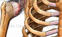 Trật khớp vai v&#224; c&#225;ch điều trị